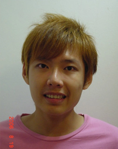 患者分享 - 張Ｏ翔