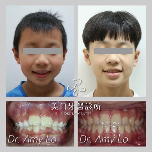 隱適美矯正 隱適美矯正