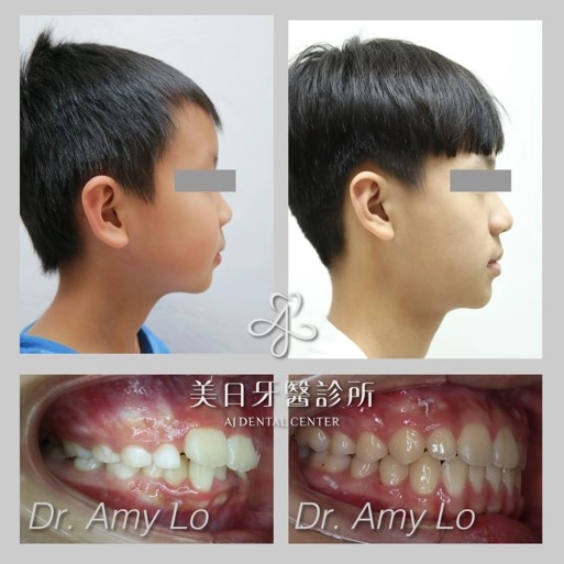 隱適美矯正 隱適美矯正