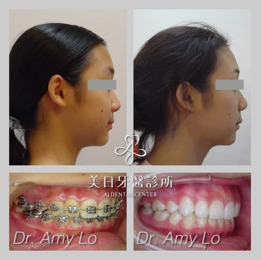 齒顎矯正 齒顎矯正