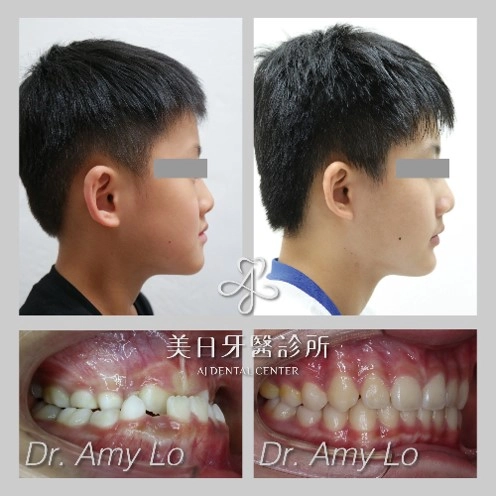 戽斗矯正 - 兒童早期生長導引 戽斗矯正 - 兒童早期生長導引