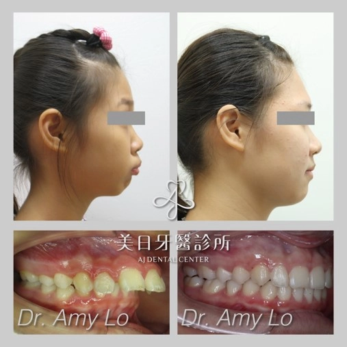 小下巴矯正 - 兒童早期生長導引 小下巴矯正 - 兒童早期生長導引