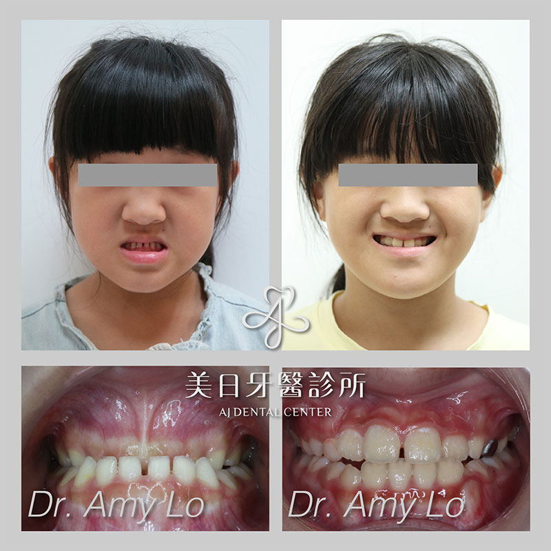 MRC肌功能矯正案例