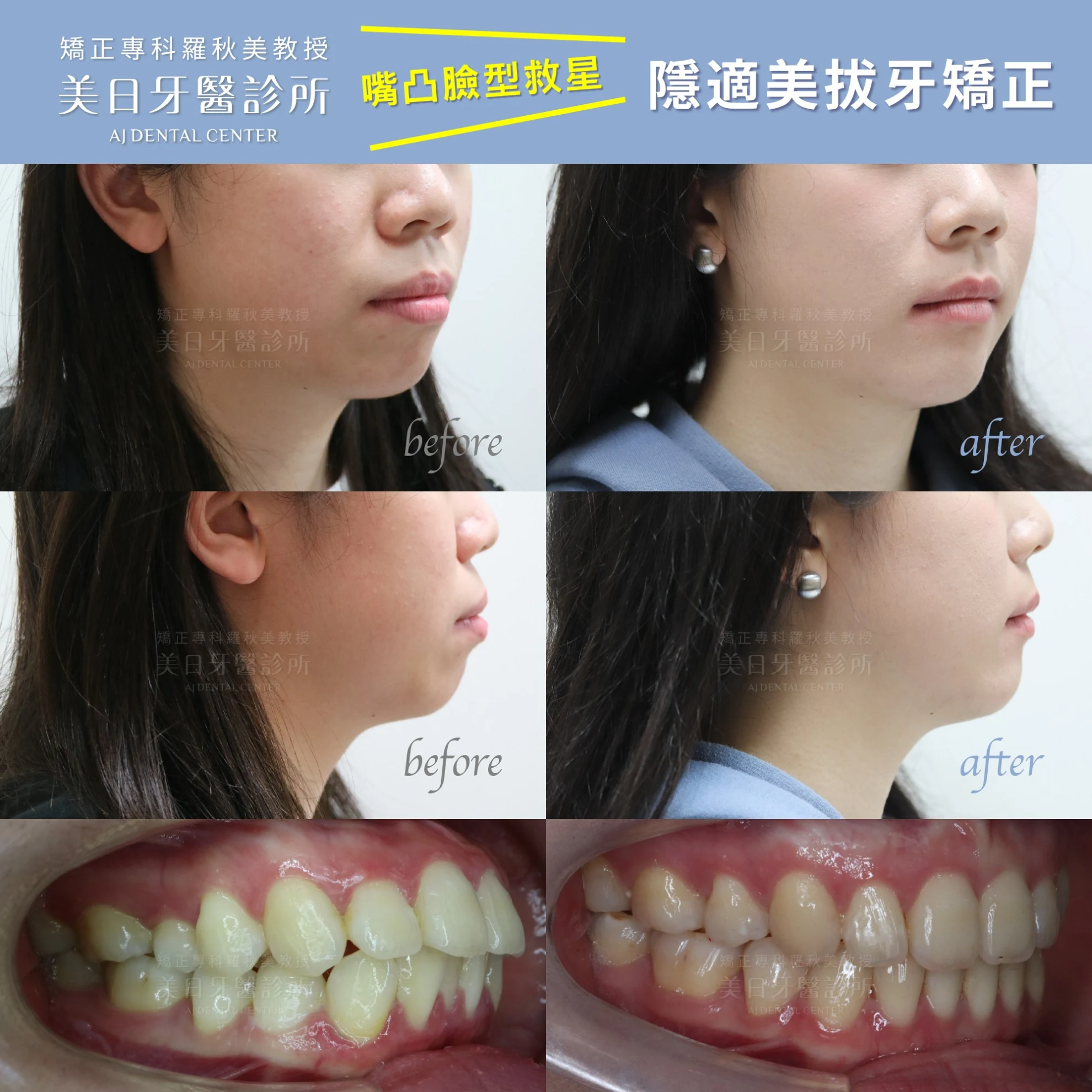 隱適美拔牙矯正 隱適美拔牙矯正