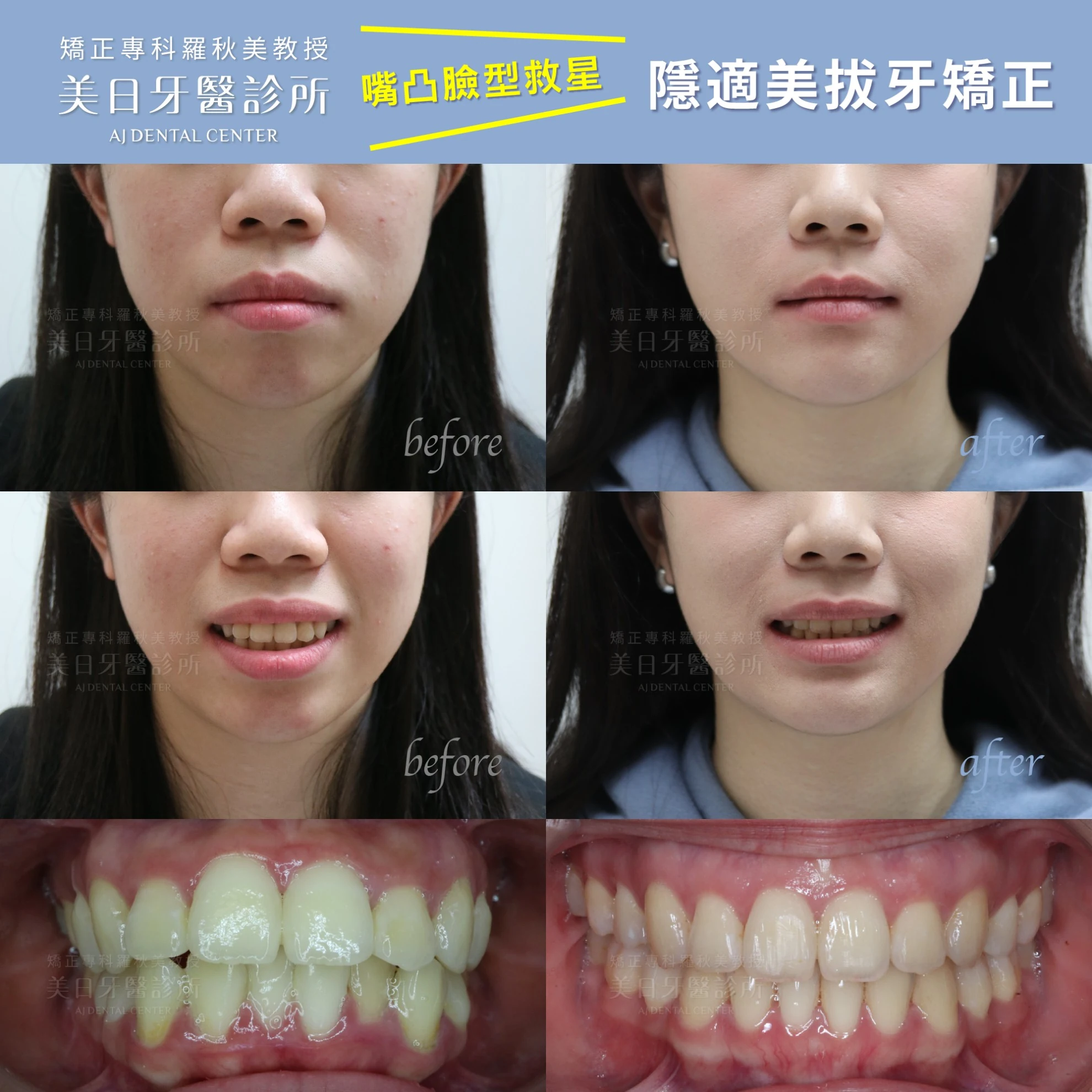 隱適美拔牙矯正 隱適美拔牙矯正