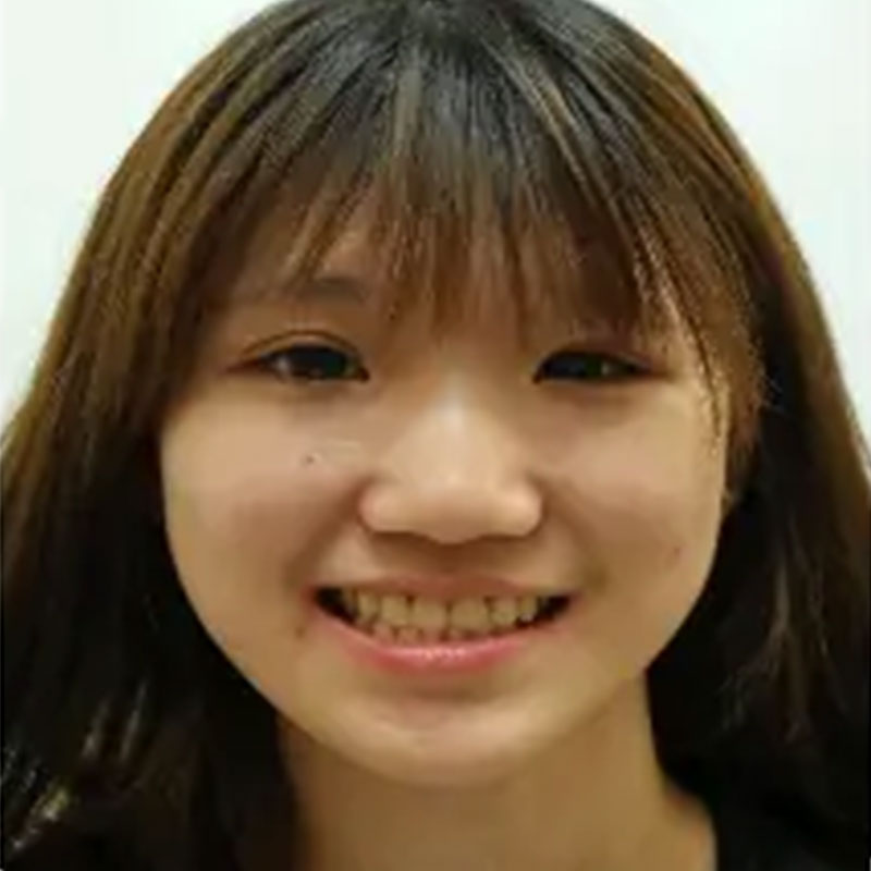 戽斗矯正案例-2