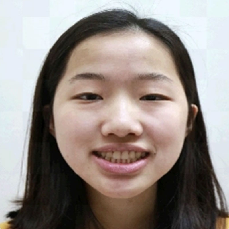 戽斗矯正案例-3