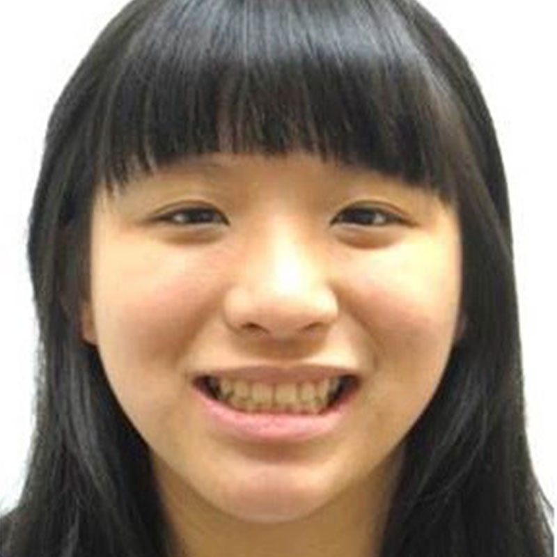 戽斗矯正案例-4