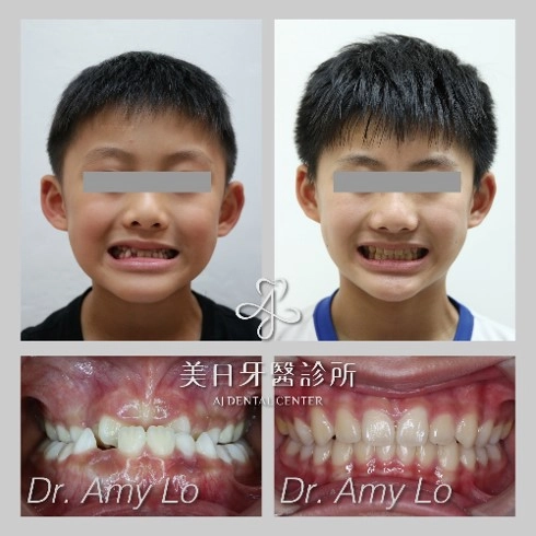 戽斗矯正案例-1