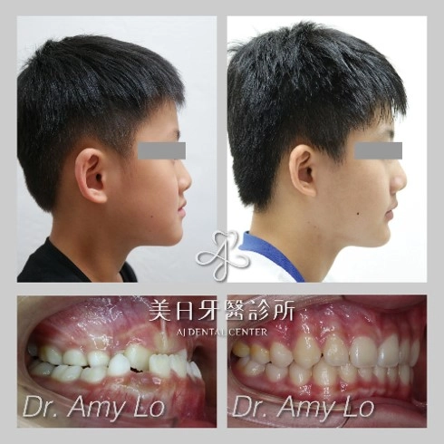 戽斗矯正案例-1