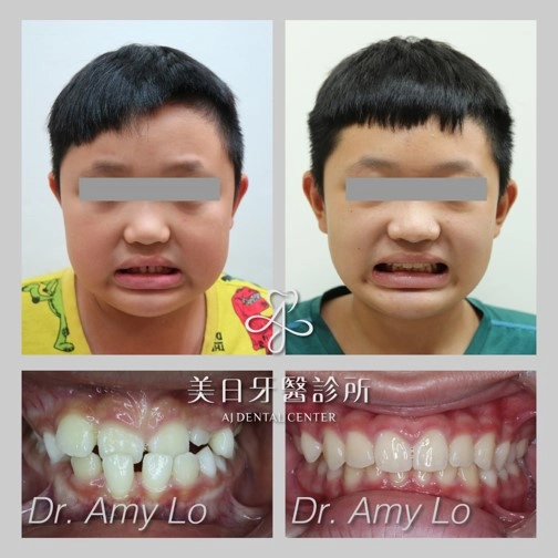 戽斗矯正案例-1