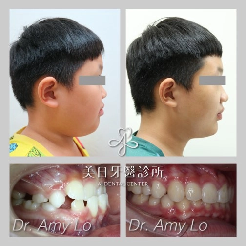 戽斗矯正案例-1