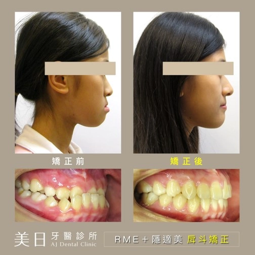 戽斗矯正案例-1