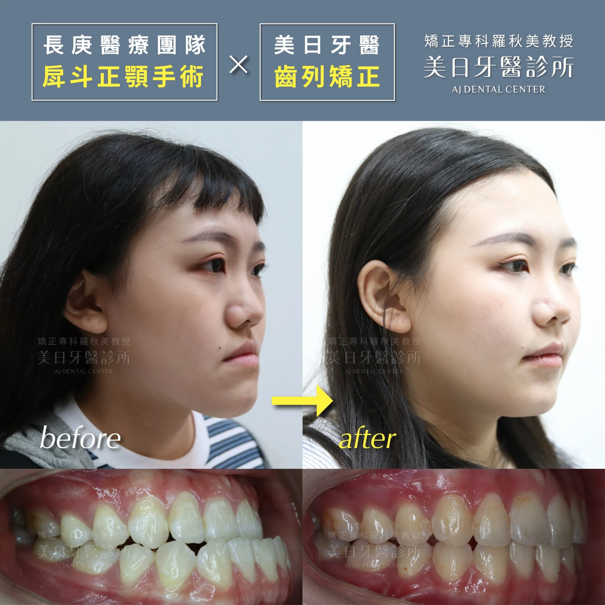 長庚醫療團隊正顎手術&美日牙醫齒列矯正
