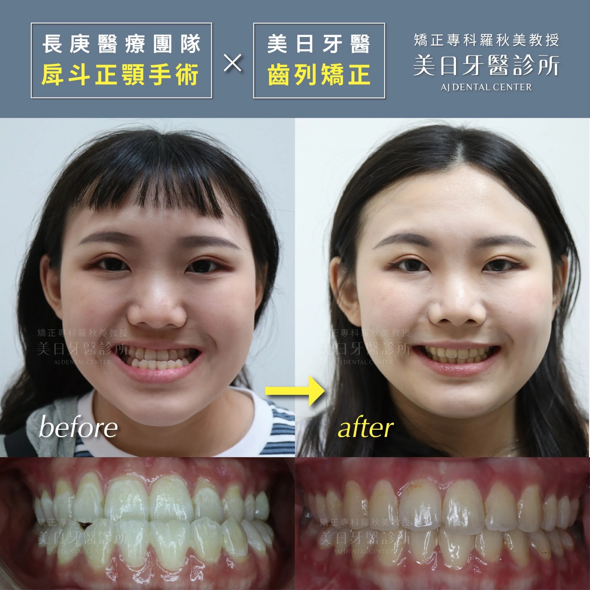 長庚醫療團隊正顎手術&美日牙醫齒列矯正