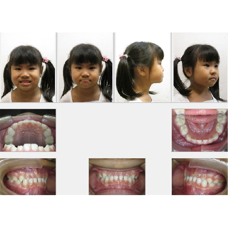 楊小妹 戽斗矯正