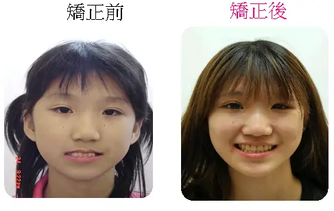 戽斗矯正案例-2