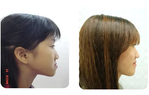 戽斗矯正案例-2