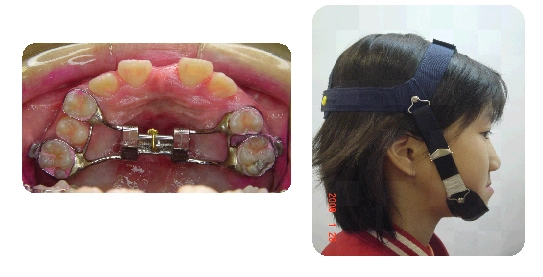 戽斗矯正案例-2