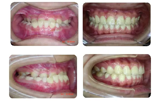 戽斗矯正案例-2