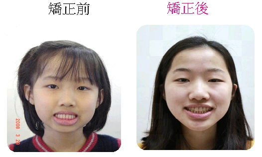 戽斗矯正案例-3