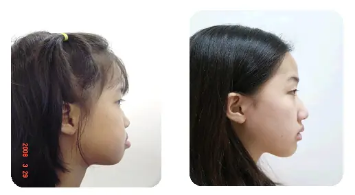 戽斗矯正案例-3