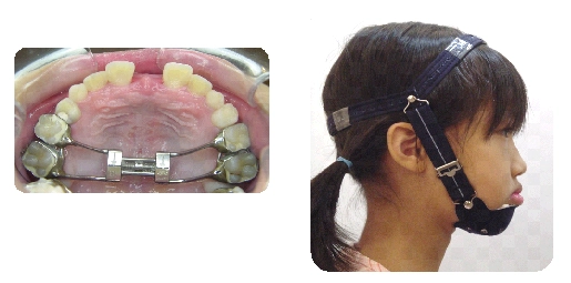 戽斗矯正案例-3