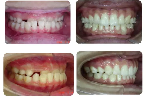 戽斗矯正案例-3