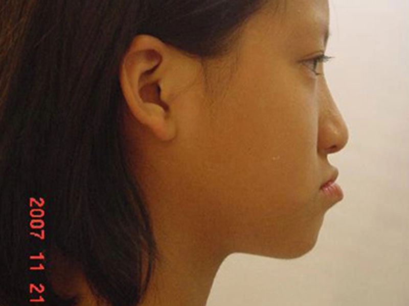 戽斗矯正案例-4