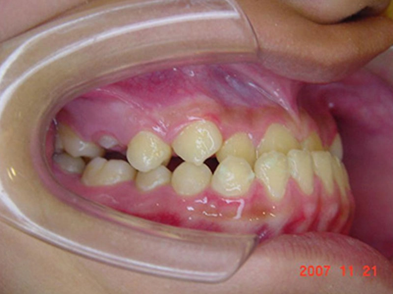 戽斗矯正案例-4
