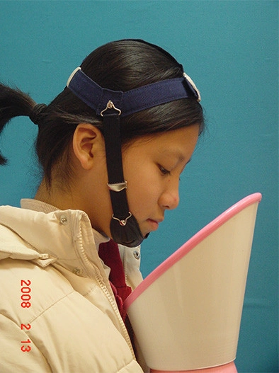 戽斗矯正案例-4