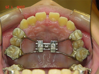 戽斗矯正案例-4