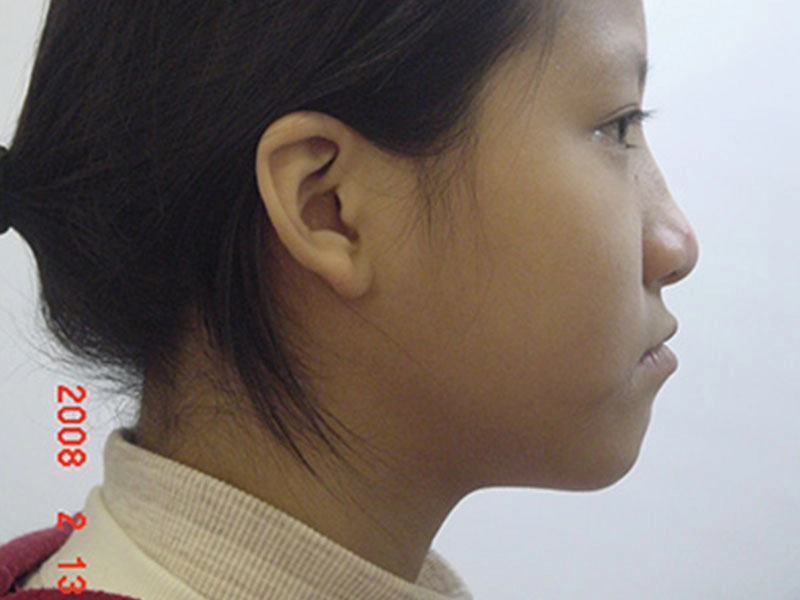 戽斗矯正案例-4