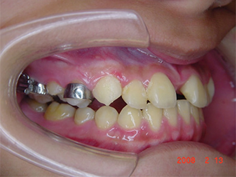 戽斗矯正案例-4