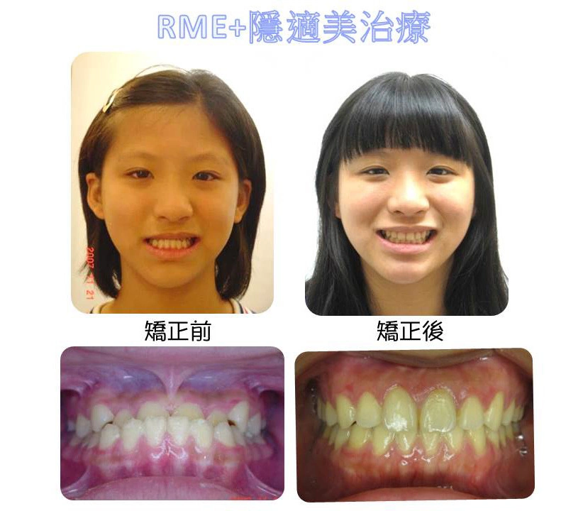 戽斗矯正案例-4