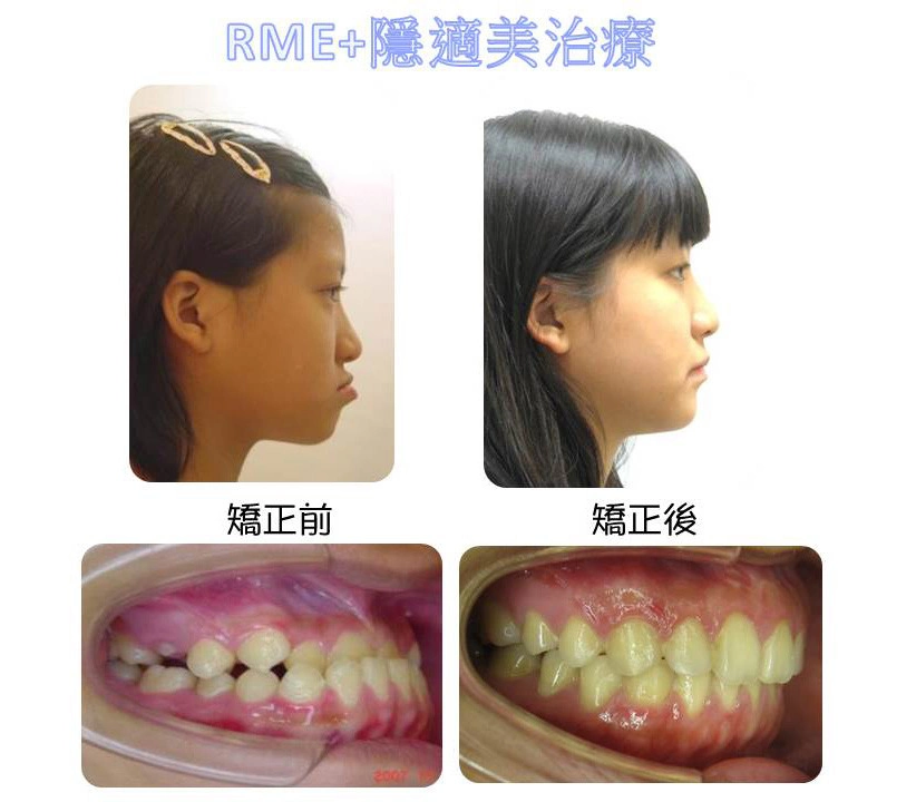 戽斗矯正案例-4