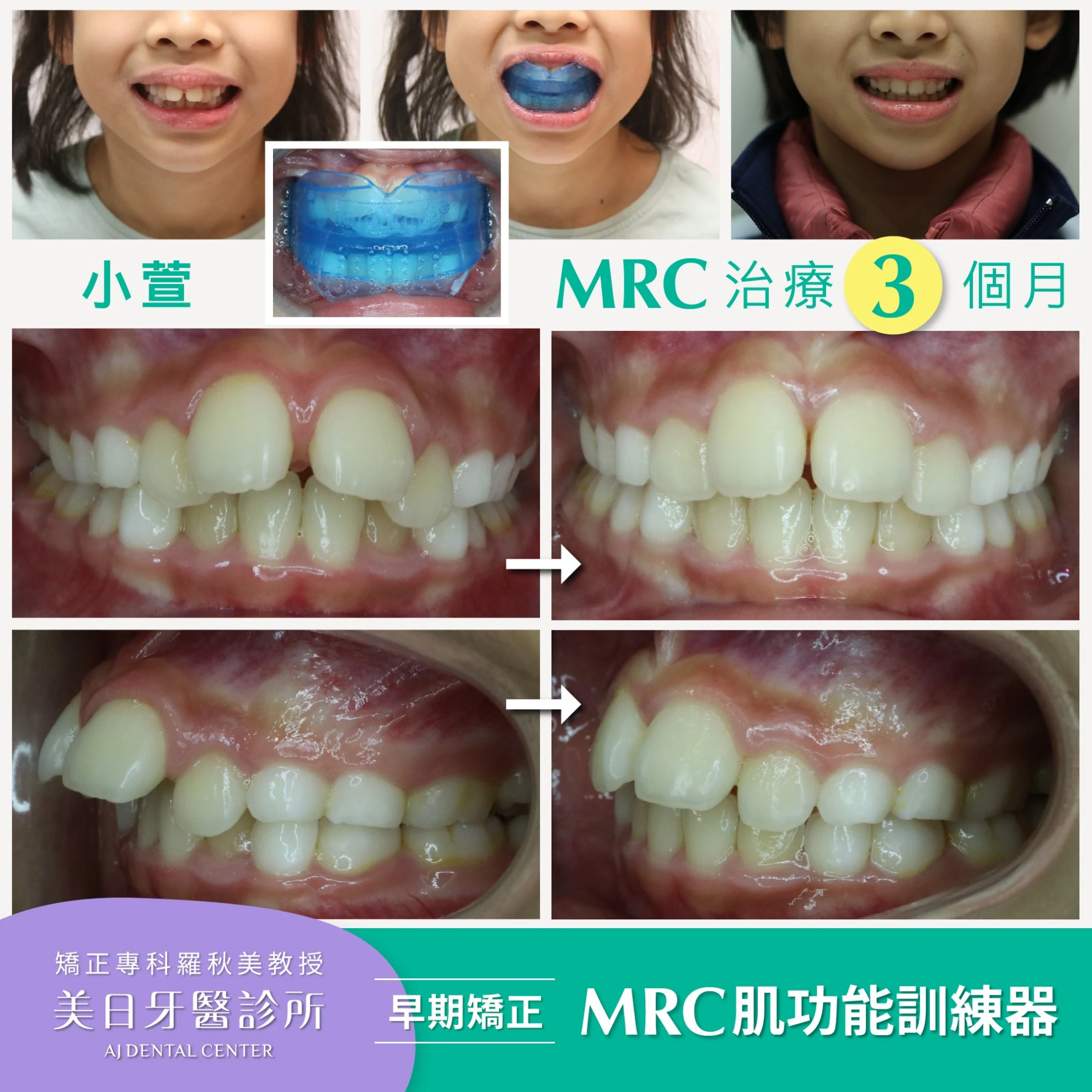 MRC肌功能矯正-小萱 MRC肌功能矯正-小萱