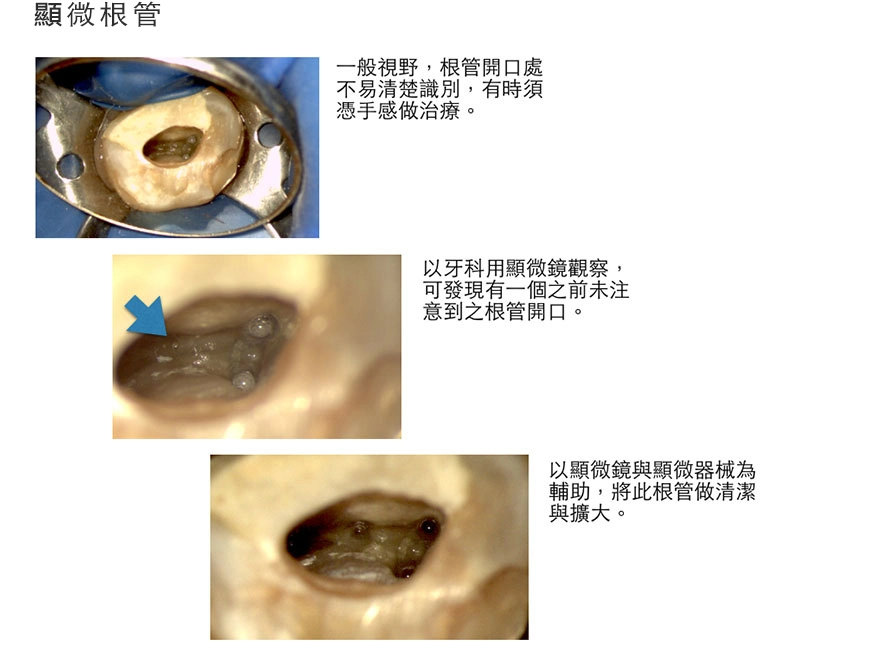 根管治療 根管治療