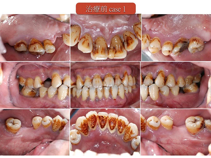 全口牙周治療