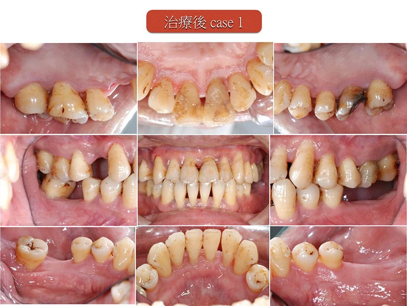 全口牙周治療