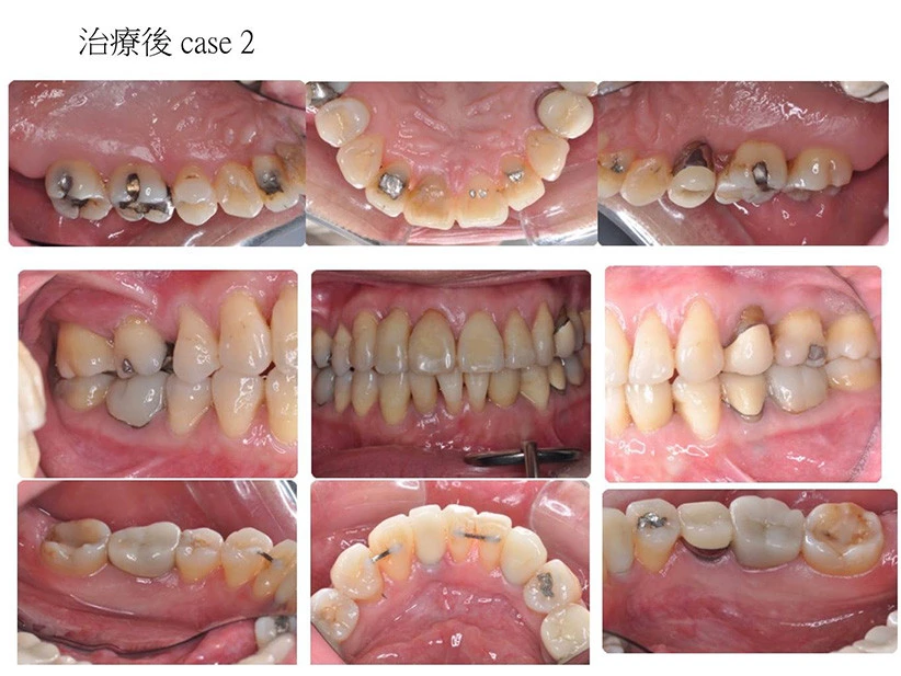 全口牙周治療