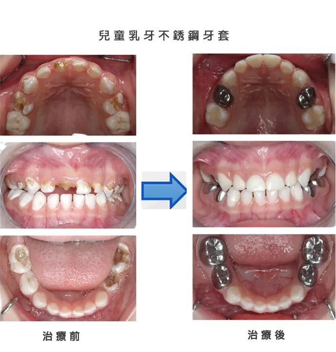 兒童牙科 兒童牙科