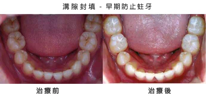 兒童牙科 兒童牙科